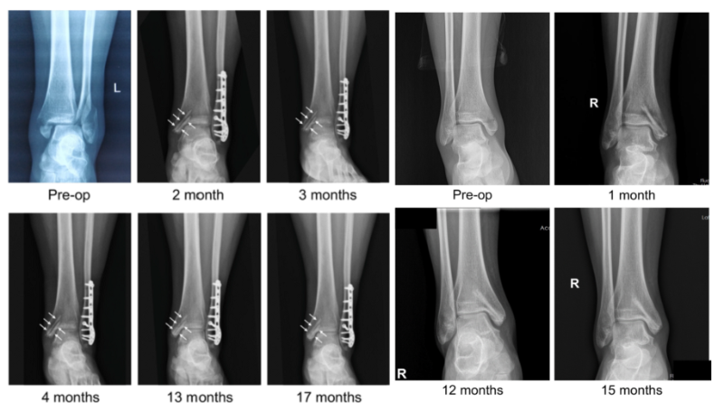 醫(yī)用鎂合金骨內植物臨床試驗研究突破性進展(圖2)