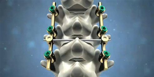 脊柱后路內(nèi)固定系統(tǒng)注冊技術審查指導原則(2016年第70號)(圖1) 脊柱后路內(nèi)固定系統(tǒng)注冊技術審查指導原則(2016年第70號)(圖1)